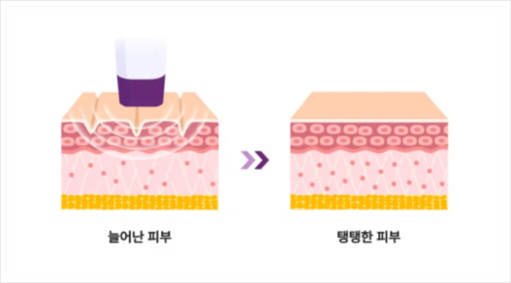  여의도역피부과 써마지FLX 효과 장점은