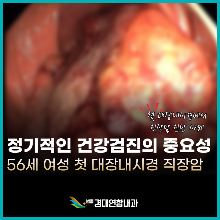  혈변이 치질인 줄 알았습니다. 56세 여성 6cm 직장암 진단 증례 케이스 - 생애 첫 대장내시경 -