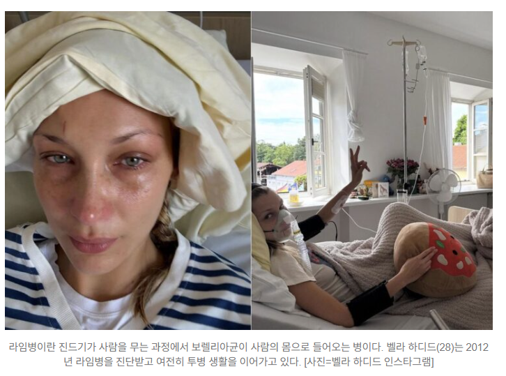 모델 벨라 하디드, 라임병 투병 근황…국내 감염도 늘고 있다 ️