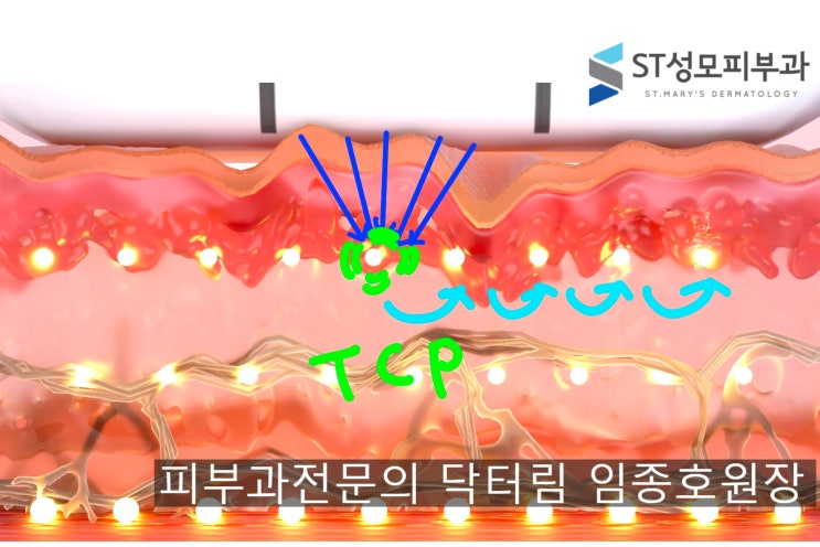 울써티 리프팅 (울쎄라+써마지+티타늄)