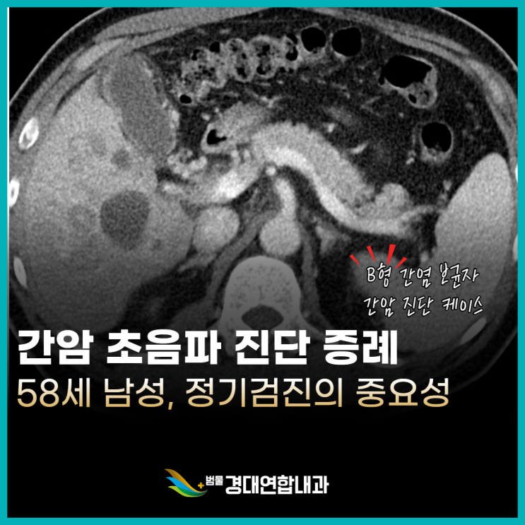  간암 초음파 진단 증상 없다고 방심하면 안되는 이유 - 범물경대연합내과 이재광 원장 작성 -