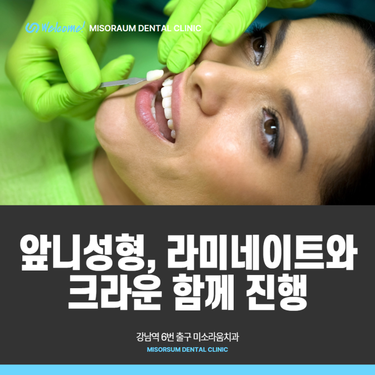  앞니 성형, 라미네이트와 크라운 함께 진행할 수 있다면