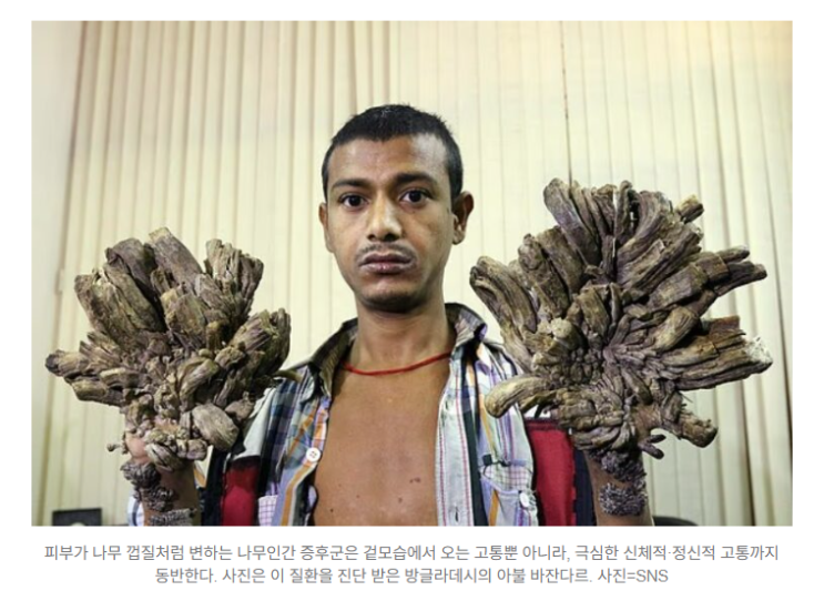  피부가 나무껍질처럼 변하는 희귀질환, ‘나무인간 증후군’의 진실 