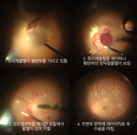 당뇨망막병증 수술, 이미 늦었다고 포기하셨나요? <실제 사례 3가지>