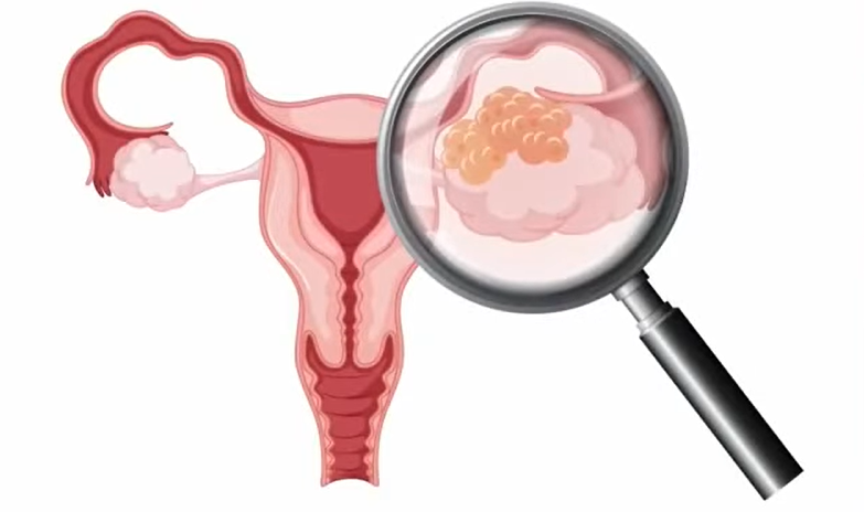 난소혹 3cm부터 6cm까지, 크기별 증상 원인 수술 난소낭종 통증 관리법