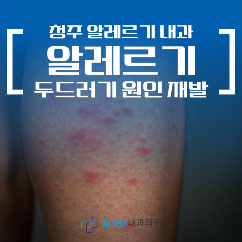 청주 알레르기 내과 알레르기 두드러기 원인, 재발 방지를 위한 방법은?