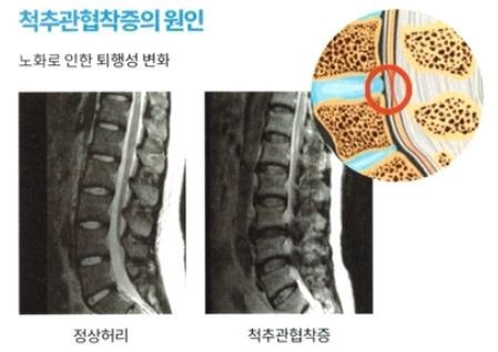  척추관협착증 증상 완화에 PEMF 요법, 진짜 효과 있을까요?