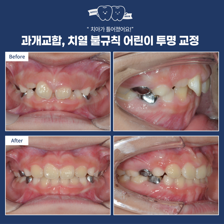  성장기 어린이 치아 불규칙, 과개교합  인비절라인 퍼스트로 쉽게 치료, 하남 어린이 투명교정