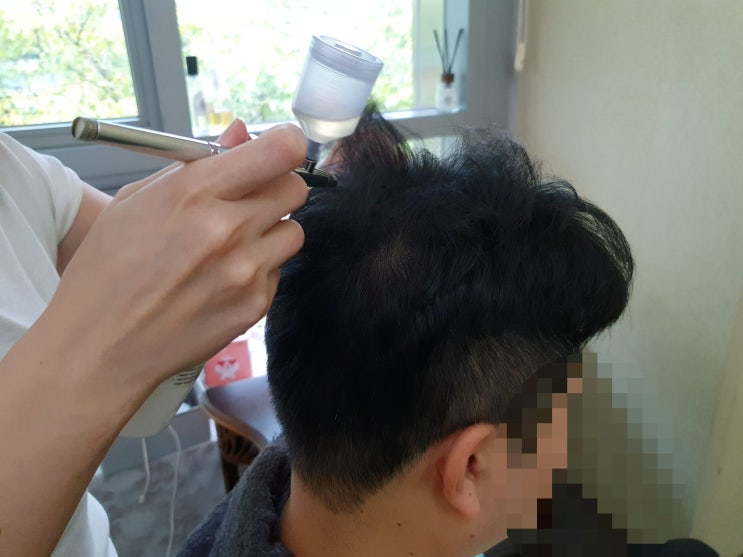 분당 탈모 꼼꼼한 WT메소드 가격 후기