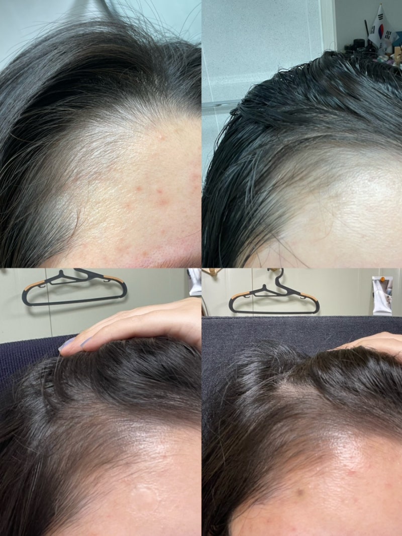 [내돈내산] 리바이탈래쉬 헤어 영양제 4개월 사용 후기 | 탈모, 헤어라인 비포&에프터 사진 공....