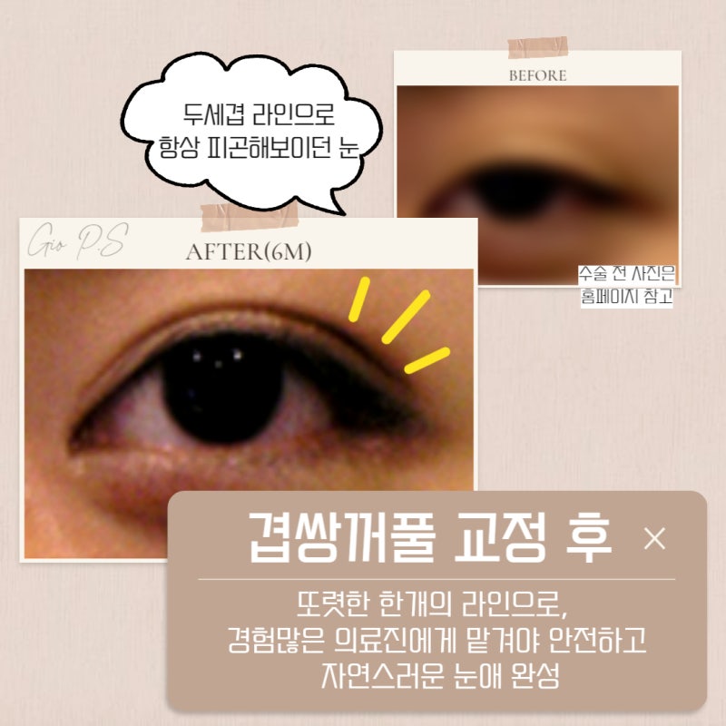 겹쌍꺼풀 교정, 겹쌍꺼풀 없애기 또렷한 하나의 라인으로 만들기위해
