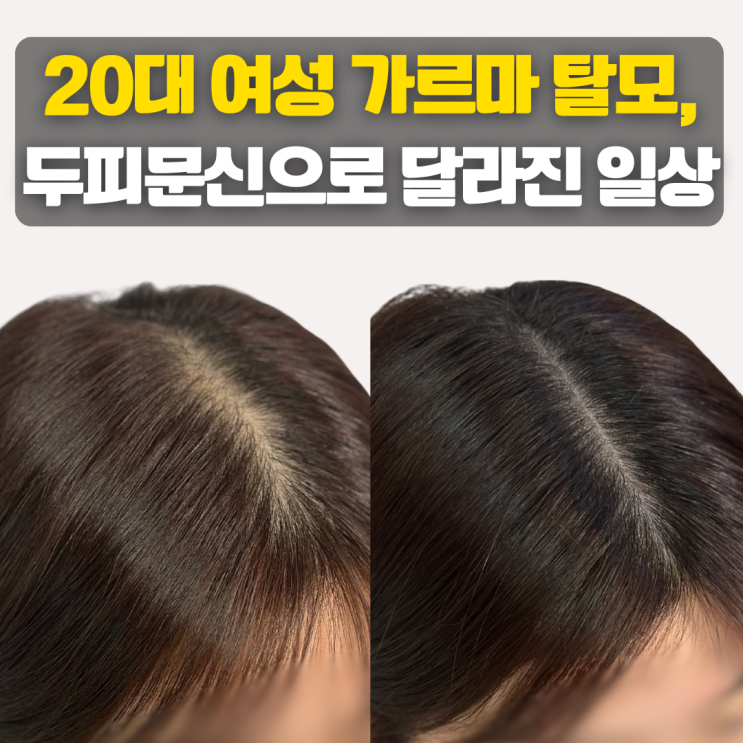  20대 가르마탈모, 부산SMP로 완전히 달라진 일상 | 실제 후기와 변화 과정!