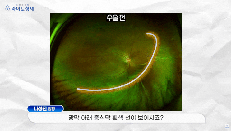  망막박리 실리콘오일, 언제 필요할까? <사례>
