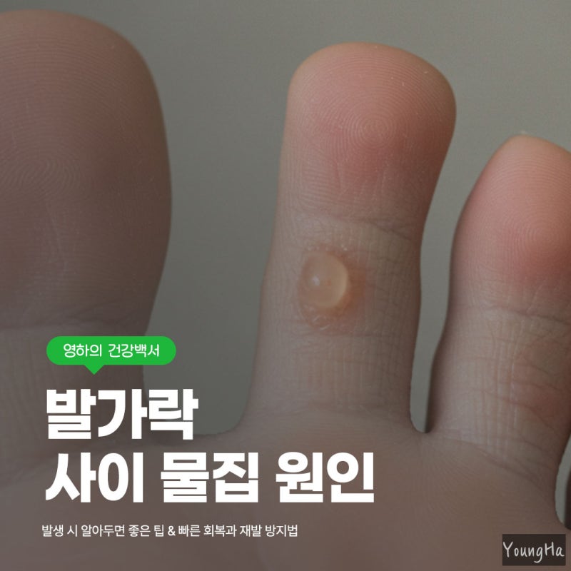 발가락 사이 물집 왜 생기나 원인부터 관리법