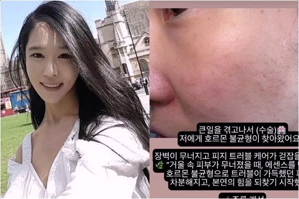  나는 솔로 16기 옥순 '유산 후유증' 눈물의 고백! 피부-호르몬 무너져 회복 응원 봇물