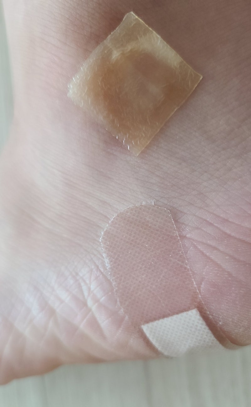 사마귀 냉동치료 실비 10번 레이저 경과 후기(사진주의)