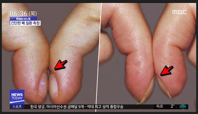 손톱 '이 모양' 이면, 폐암초기증상 의심