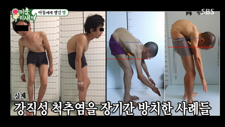 <b>이동건</b> 난치병 <b>강직성 척추염</b>은 어떤 질환일까?