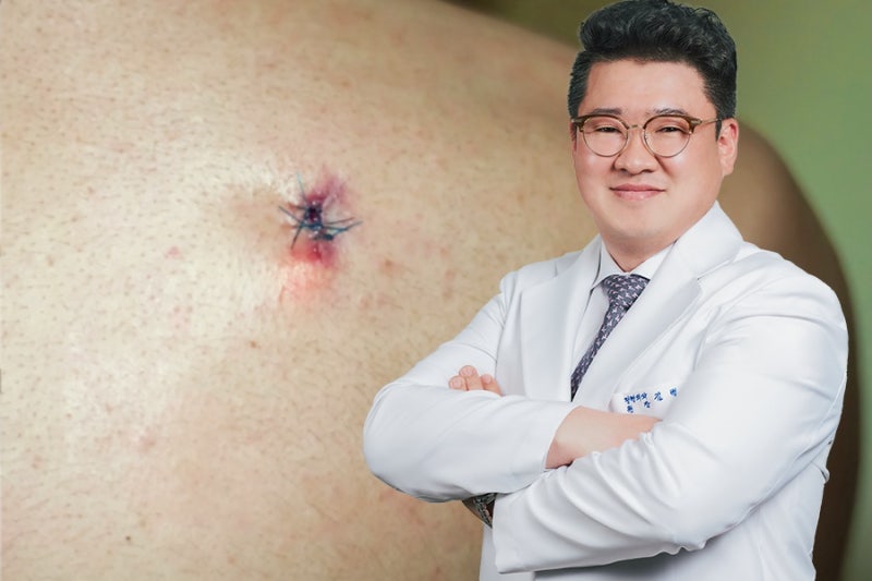 평택 표피낭종·피지낭종 제거, 언제 어떻게 해야 할까요?