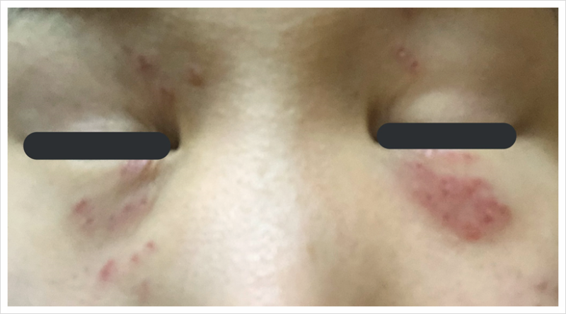 한관종 아그네스 후기 레이저 효과, 가격까지 솔직 정리