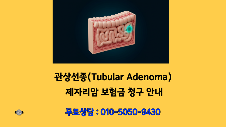  "Tubular adenoma"  진단 제자리암인지 확인해야 하는 이유