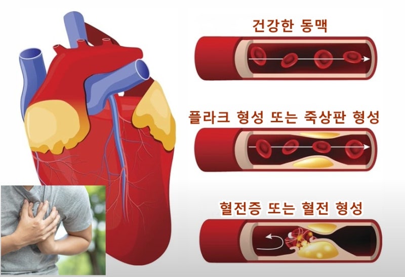 관상동맥 석회화 원인 수치 지수 점수 CT·MDCT 검사 진단 치료 예방