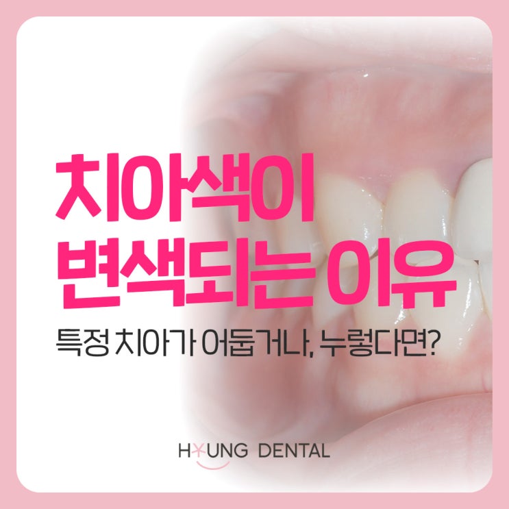  치아의 색이 변하는 이유, 수원 어린이교정 전에 확인!