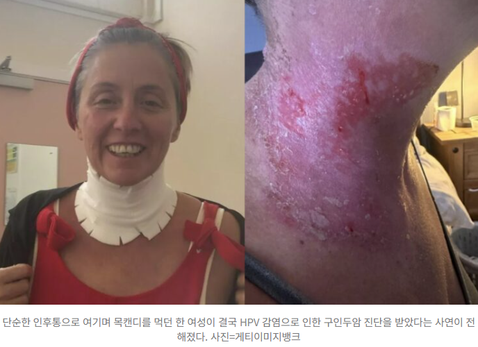  “목캔디로 버티다 암 진단… 구강 HPV 감염, 조기검진·백신이 답이다”