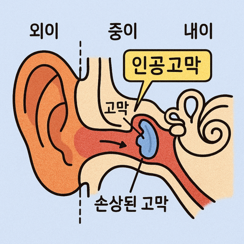 인공고막, 귀 손상 치료의 새로운 대안