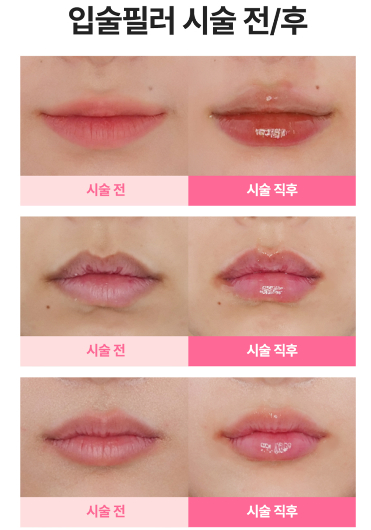  입술필러 어디서 할까? 신논현 성형외과 잘하는곳 고르는 팁