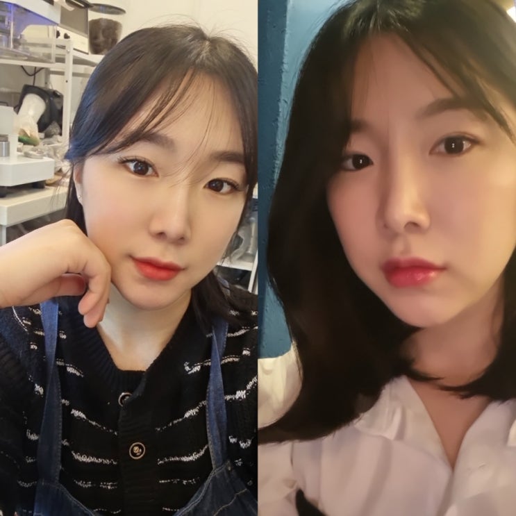  썸블리의원에서 입술필러 몰딩 진짜 잘해요 찐후기(일주일 후기)