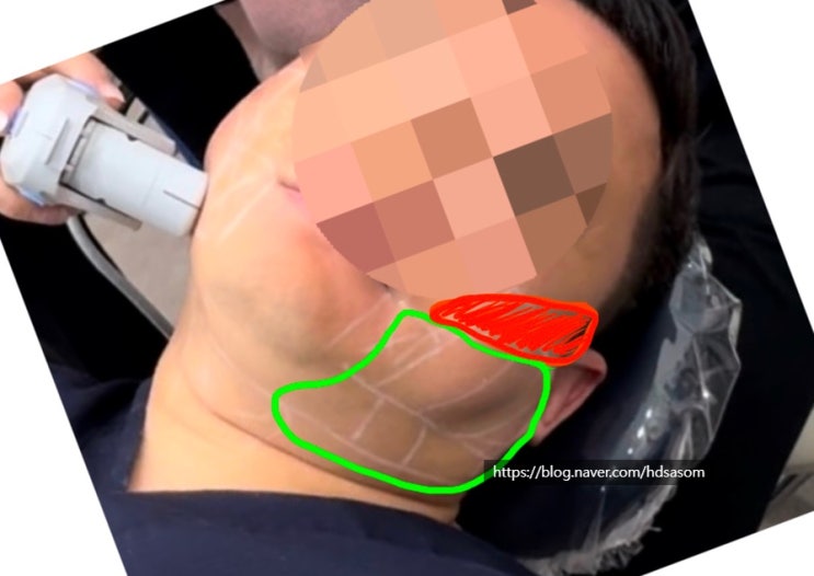  이중턱살제거 (수술 말고 레이저와 주사를 이용한 방법) - 피부과전문의 닥터림