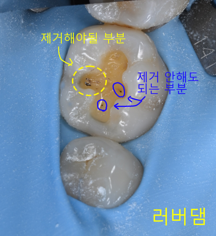  성남 레진빌드업 치과, 충치 생기고 오래된 레진 부분 교체하여 레진빌드업 한 케이스