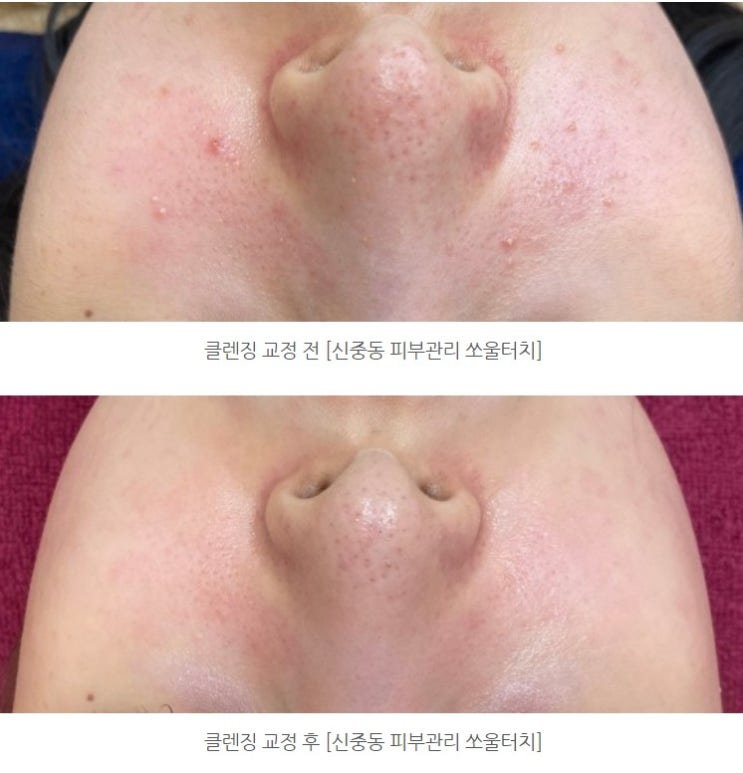  신중동피부관리 붉은 민감피부(홍조)잠재울 수 있을까요?