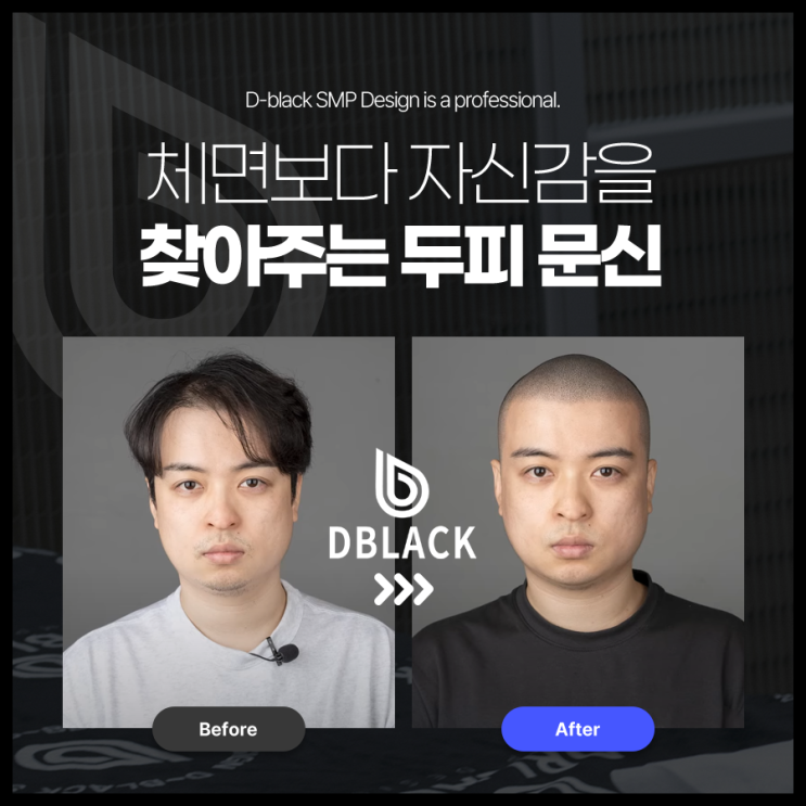  탈모로 인한 스트레스를 해결 할 수 있는 두피문신