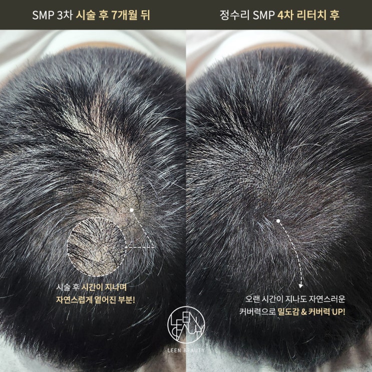  정수리부분가발 보다 좋은 정수리커버 반영구시술