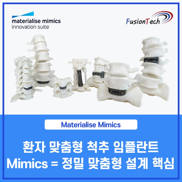 [Materialise S/W] 정밀 맞춤형 설계의 핵심, Mimics를 통한 환자 맞춤형 척추 임플란트