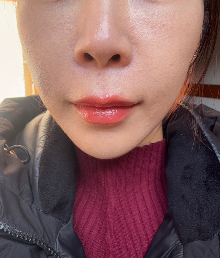  명동피부과 스킨부스터 포텐자콜라스터효과 모공축소 찐후기