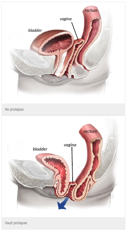  질 탈출증 교정 방법 중 천골 질 고정술 Sacral Colpopexy