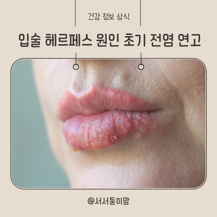  입술 헤르페스 원인 초기 전염 연고 성병일까