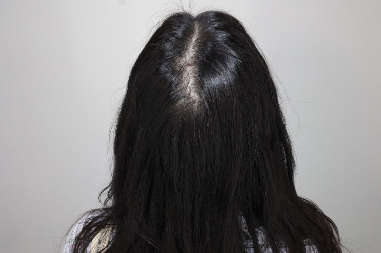  부산 여성 가르마 탈모부터 남성 정수리 탈모까지, 감쪽같이 채우는 법.