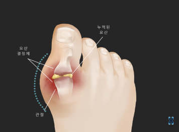 통풍 예방 약물 요법 - 요산 수치 낮추고 재발을 막자