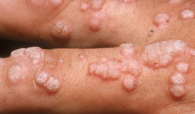 HPV 성병 인체유두종바이러스 빨리 낫는 방법, 헬스장 수건으로 옮나? HPV 성병 인체유두종바이러스 빨리 낫는 방법, 헬스장 수건으로 옮나?