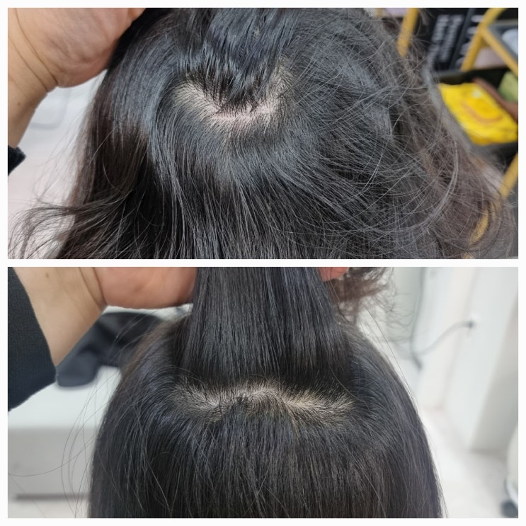  [군산 두피관리] 수송동 문제성 두피 모발관리 뷰티앤하라힐즈