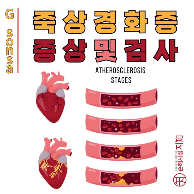  죽상경화증, 당신의 혈관은 안녕하신가요? - [엄마의 질병, 1부]