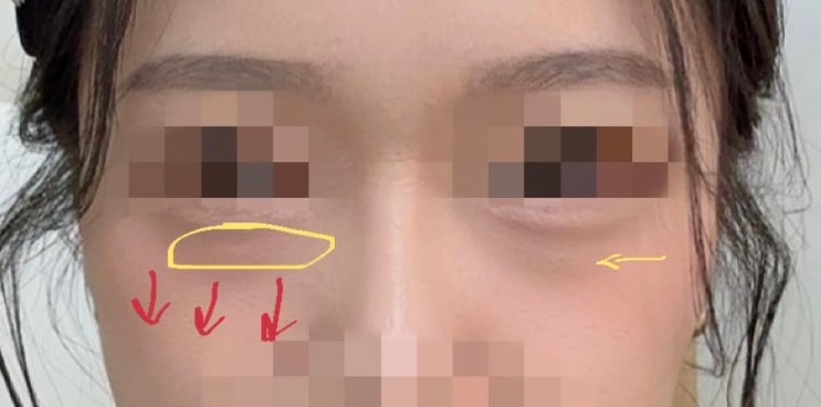  [눈밑지방재배치3] 강남/선릉 성형외과 눈밑지 수술 당일 후기, 커플성형, 동반성형