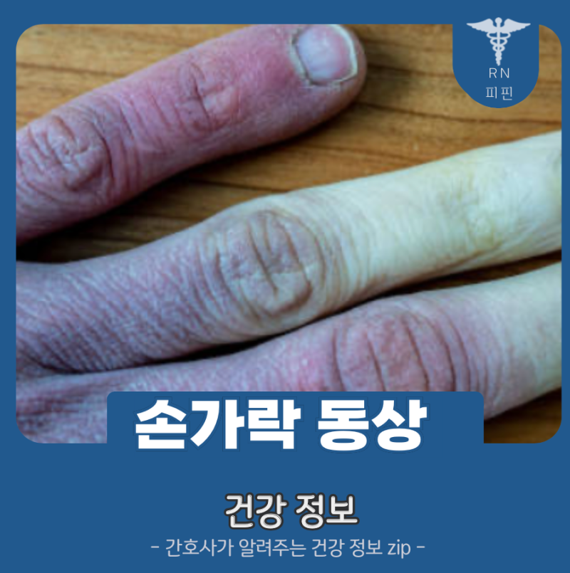 손가락 동상 증상 이것만은 피하자