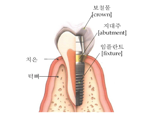 임플란트, 보험금 지급 거절 "영구치 발거 진단확정일 미확인" 임플란트, 보험금 지급 거절 "영구치 발거 진단확정일 미확인"