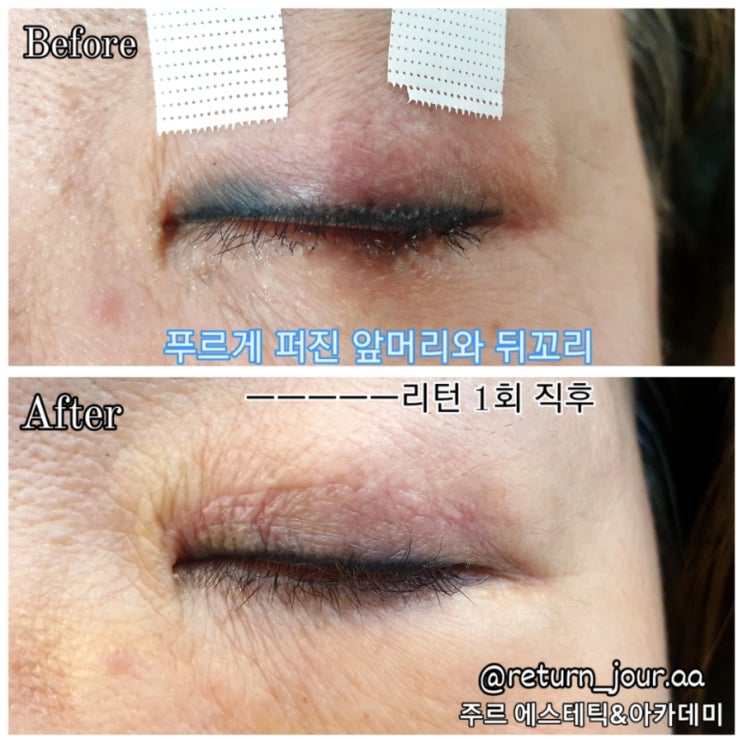  ️아이라인 제거️부산 반영구 제거 주르 에스테틱