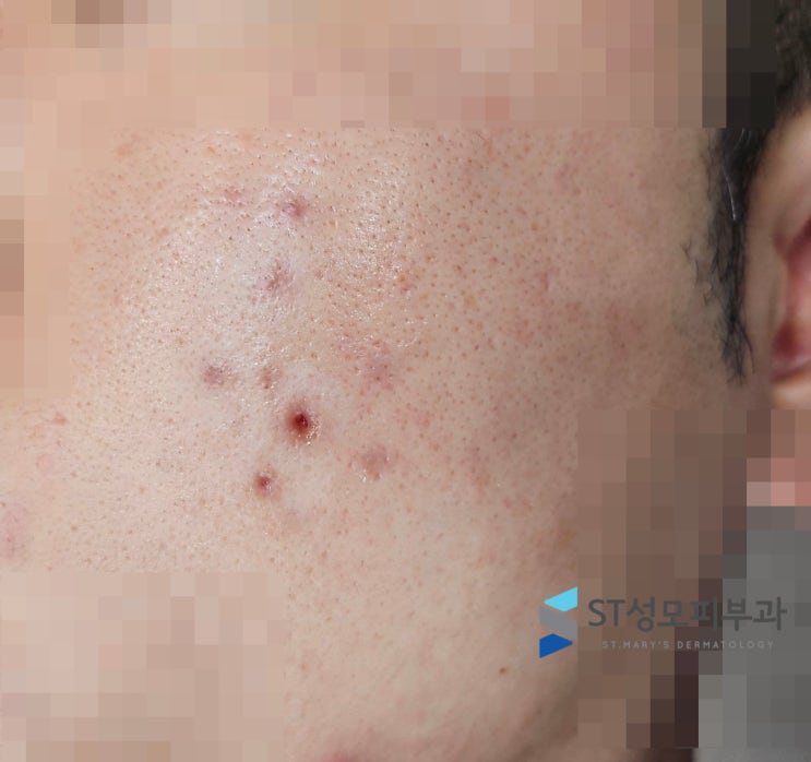  여드름 흉터 서브시전 타의원 시술 후 부작용 케이스, 개선 사례 - 피부과전문의 닥터림